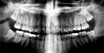 Official x-ray of my teeth.