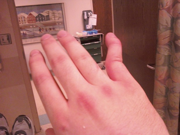 dislocated, broken pinky finger